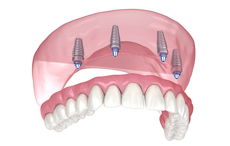 Full Arch Dental Implants