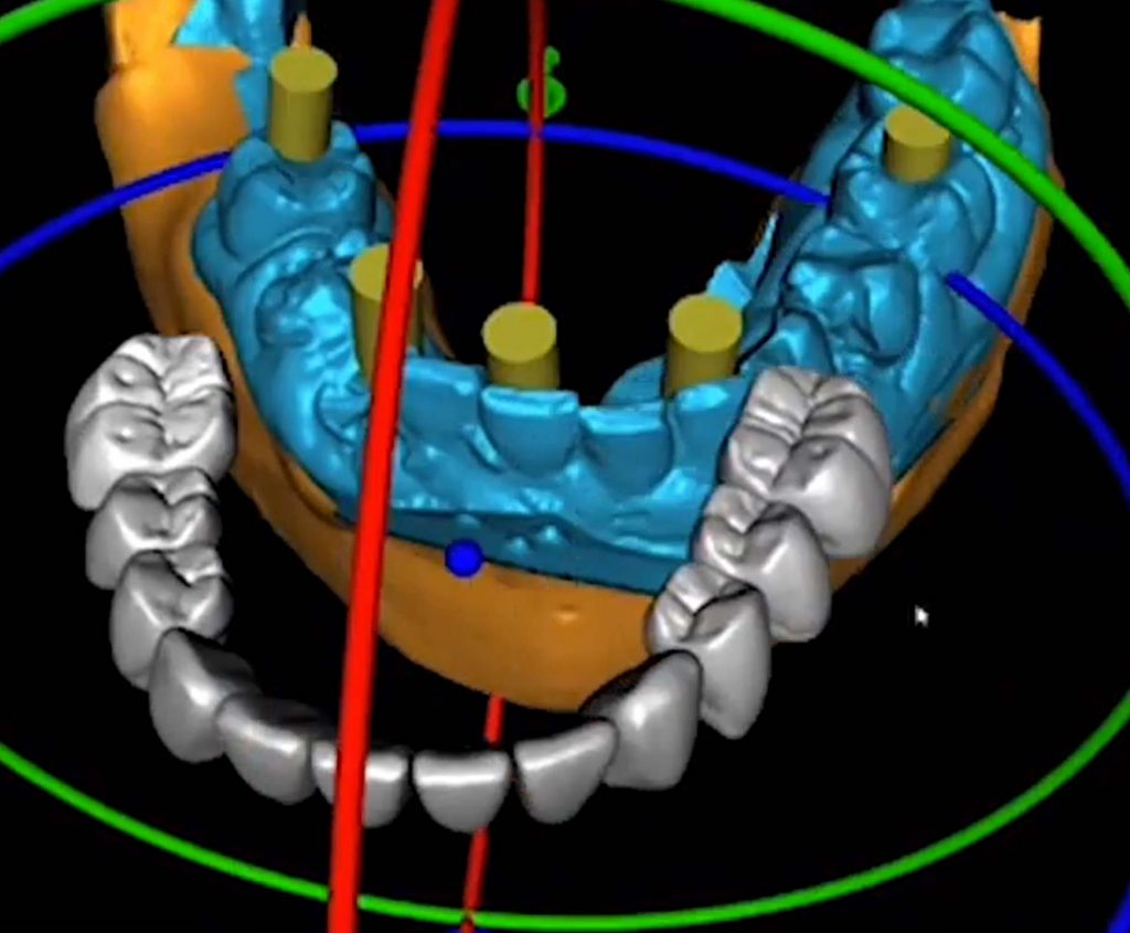 technology use in dental implants