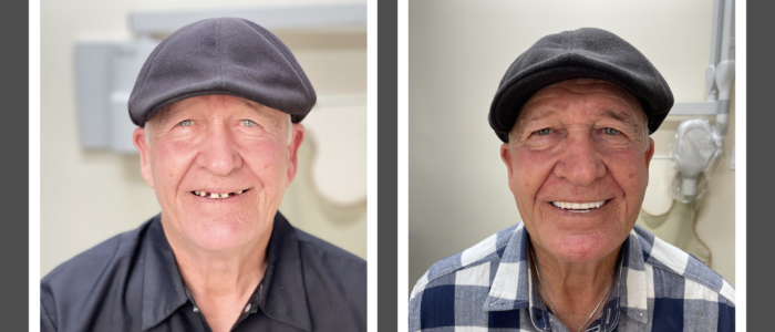 elderly man with restored smile after fixed dentures