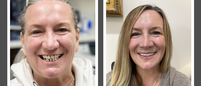 woman with restored smile after fixed dentures all-on-4