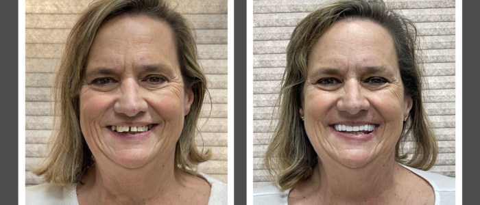 woman with restored smile with dental implant dentures