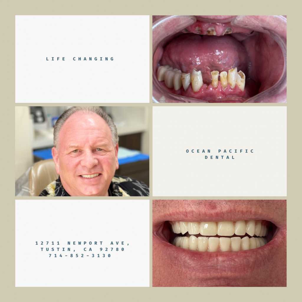 all-on-4 dental implant before and after with patient smiling